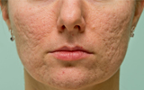 ACNE SCARRING