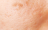 LARGE PORES