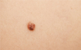 MOLE & WART REMOVAL