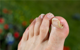 NAIL FUNGUS