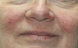 ROSACEA